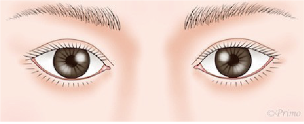 二重修正術 後の目元イラスト